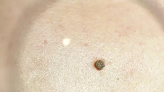 012223_abcnews_melanoma911219