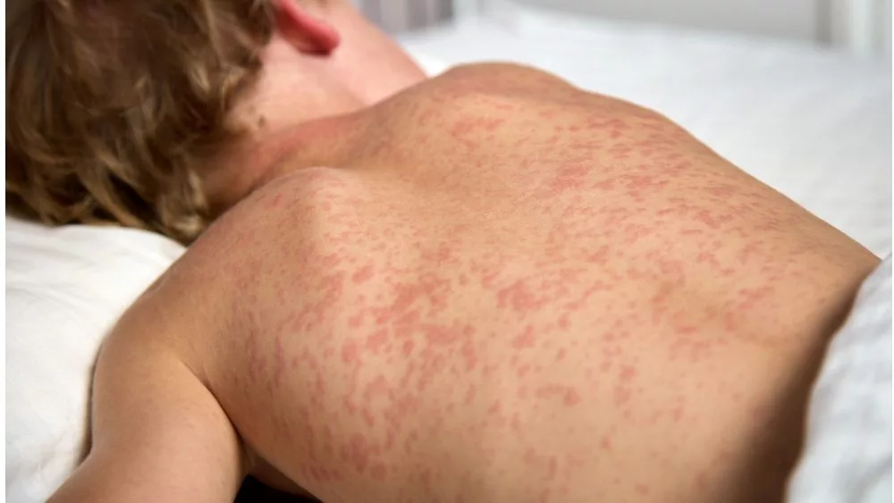 child with measles lying on the bed /asleep.