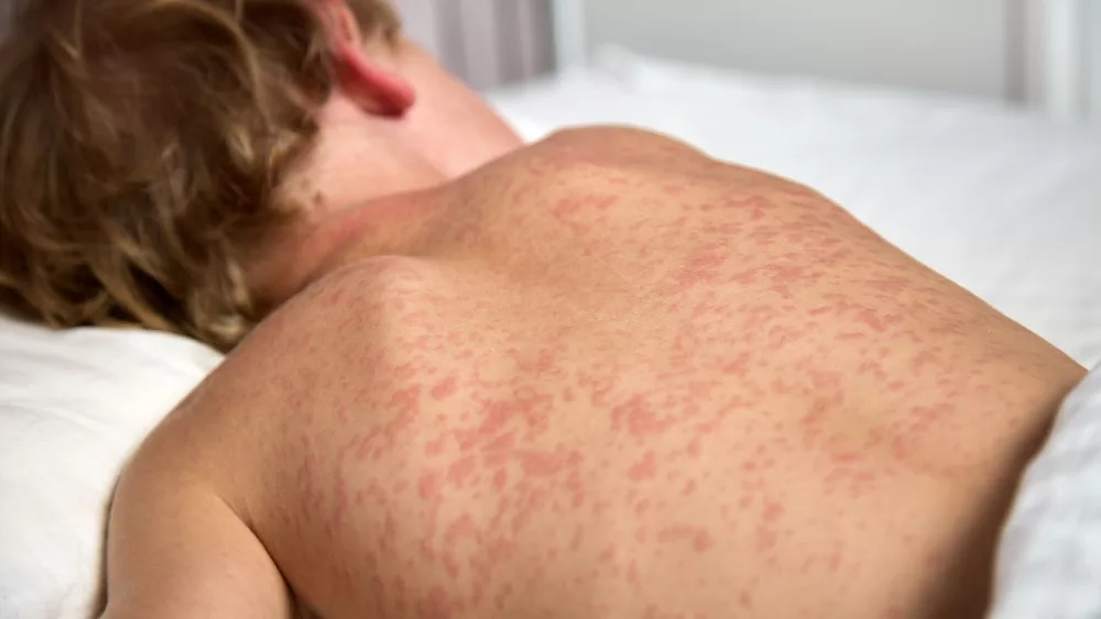 close up of the back of a child laying down in bed with the measles rash on his back