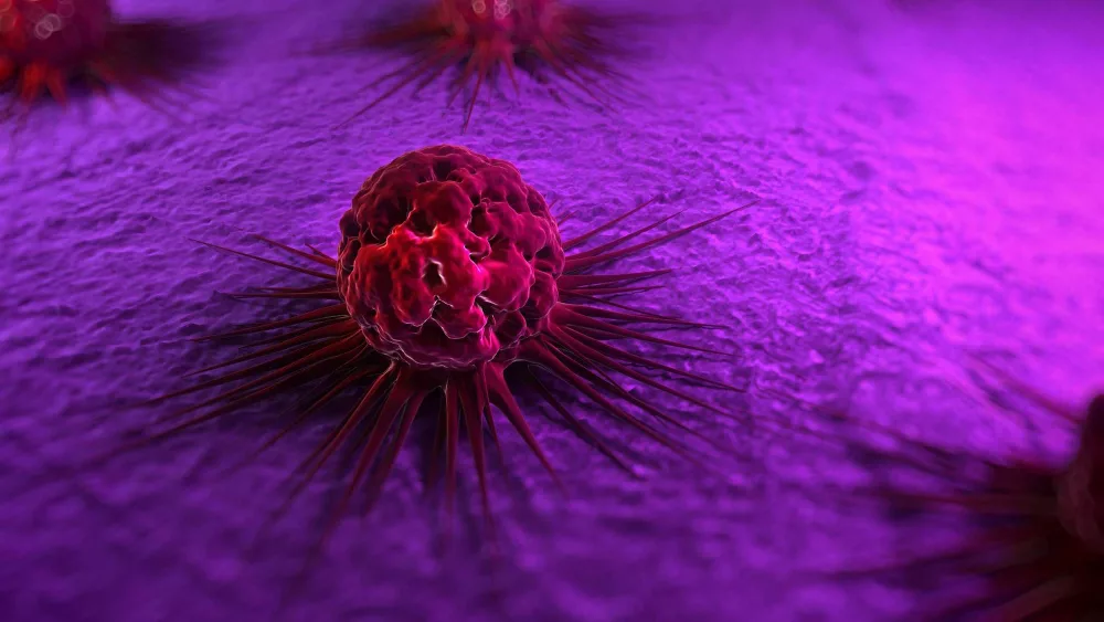 Have you heard of 'Stage 0' breast cancer? A doctor explains