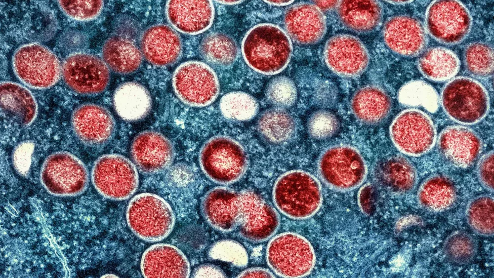 United States' first known case of more severe strain of mpox confirmed in California