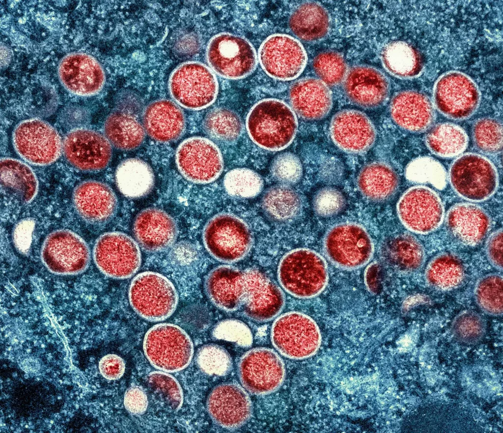 United States' first known case of more severe strain of mpox confirmed in California