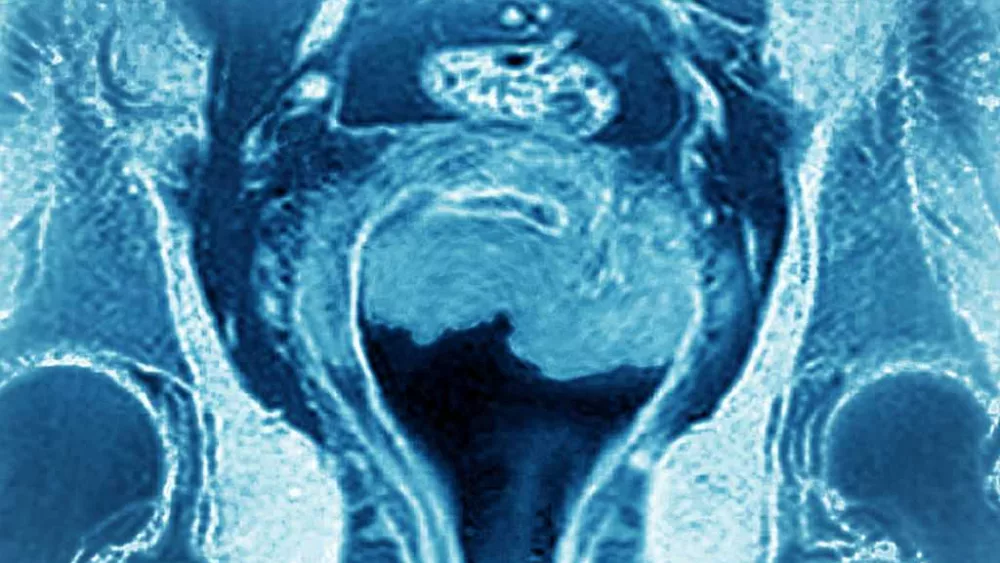 Uterine cancer among most common forms of cancer. A doctor explains what to know about it