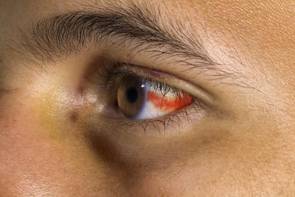 What to know about the outbreak of ‘bleeding eye’ virus