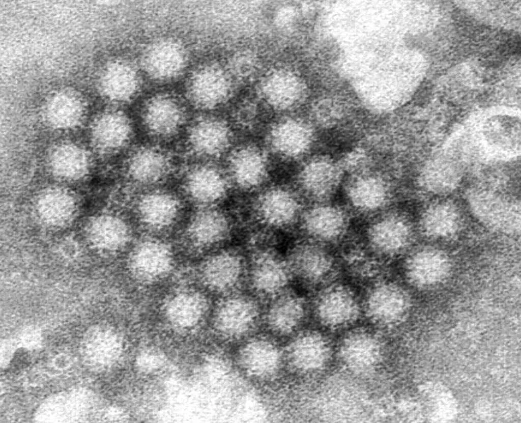 Norovirus surge in US: CDC data and prevention tips