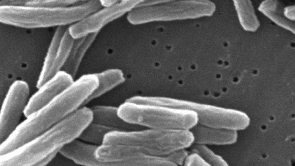 Tuberculosis cases in the US rose to their highest levels in more than a dozen years