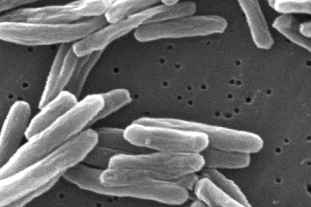 Tuberculosis cases in the US rose to their highest levels in more than a dozen years