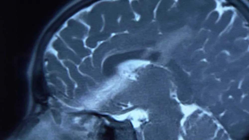 9-year-old boy survives after arrow pierces through his brain in freak accident