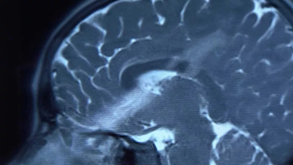 9-year-old boy survives after arrow pierces through his brain in freak accident