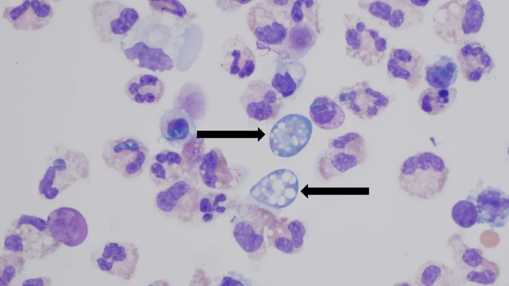 Person in Missouri contracts rare 'brain-eating' amoeba; had visited Lake of the Ozarks before falling ill