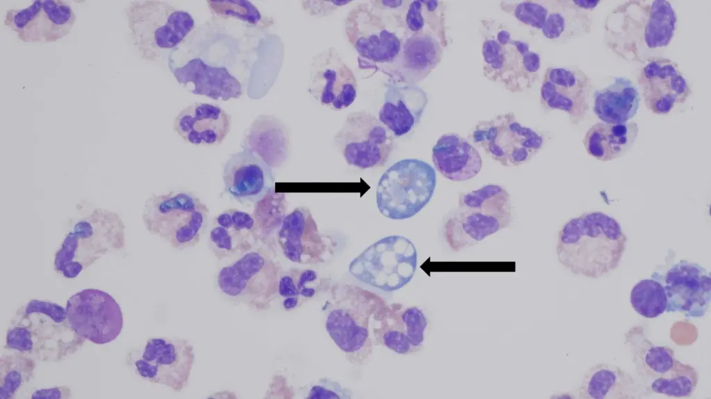 Person in Missouri contracts rare 'brain-eating' amoeba; had visited Lake of the Ozarks before falling ill