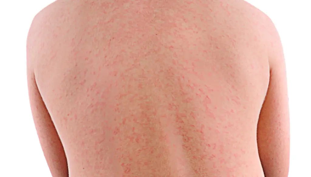 South Carolina health officials urge vaccinations after latest measles case confirmed