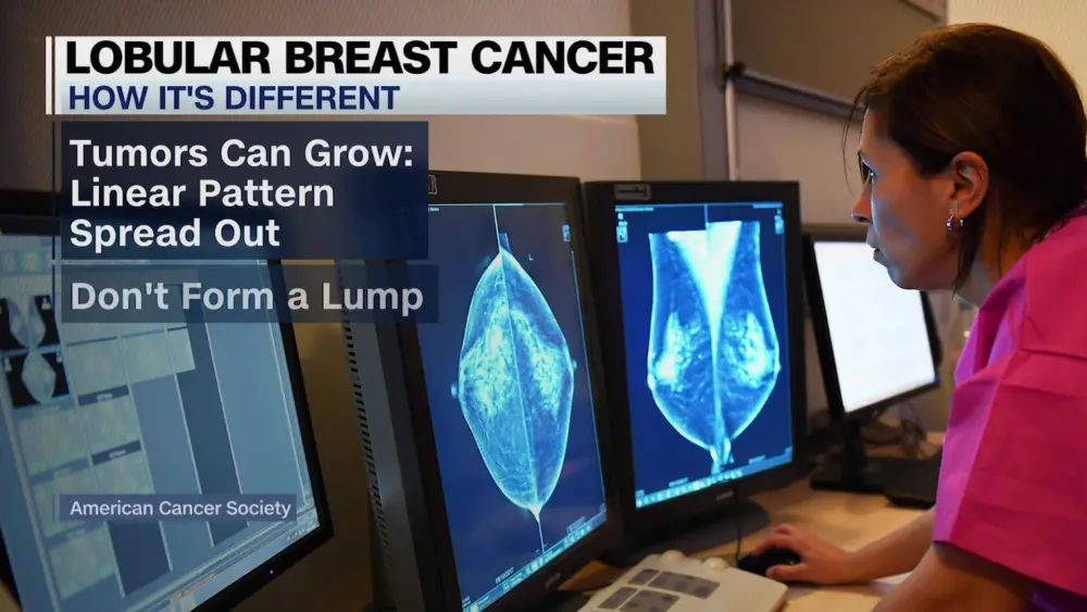 What to know about the lesser-known breast cancer type on the rise