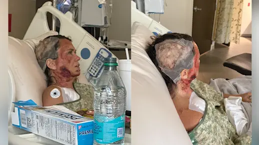 Photos show severity of burns in Forsyth Park chemical attack; search for suspect continues