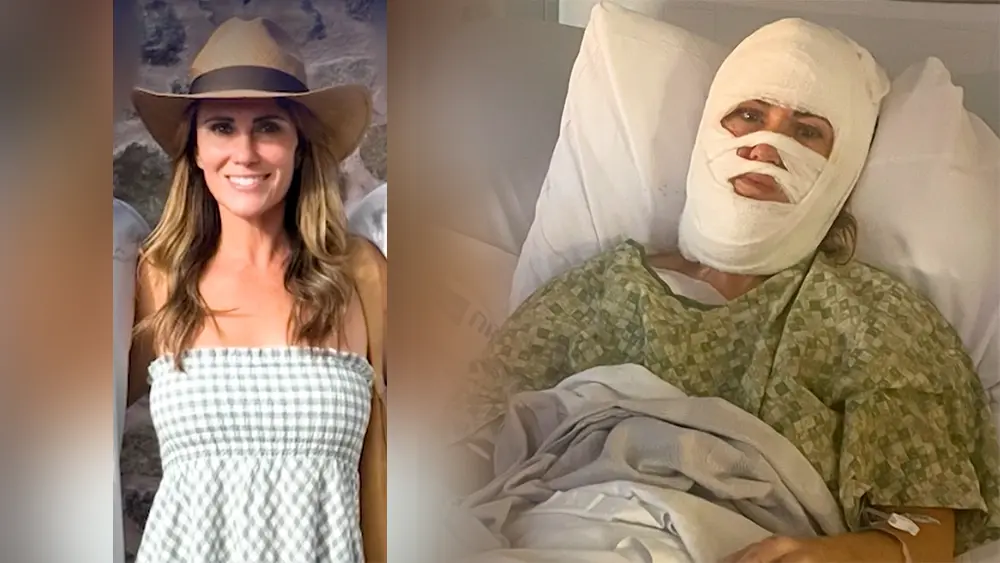 Family: Victim to undergo hair transplants after fourth-degree burns in Forsyth Park acid attack