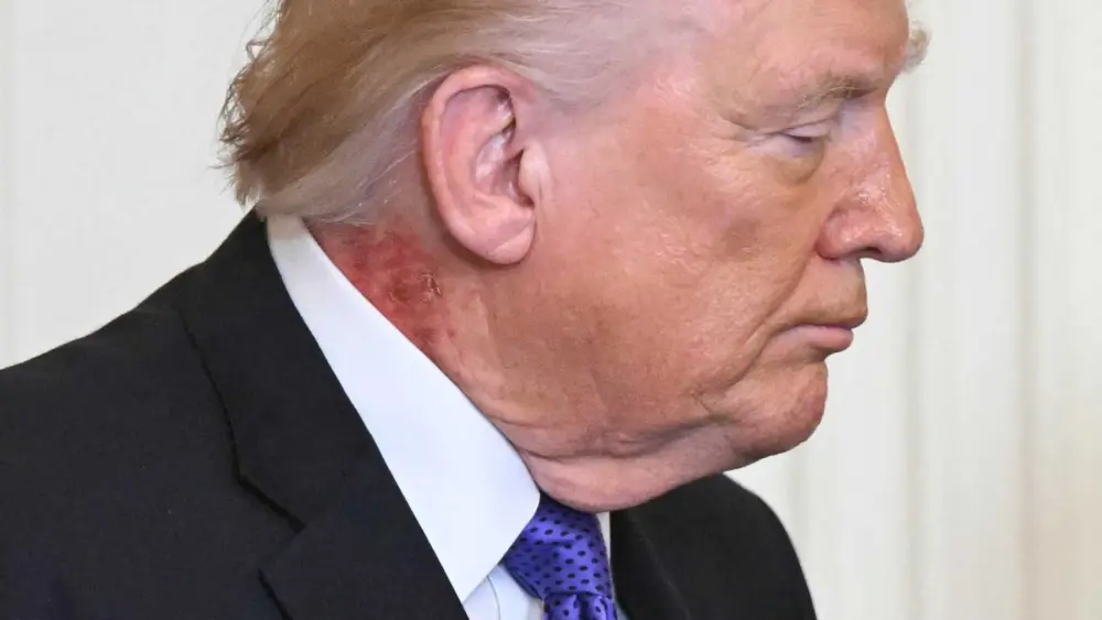 Redness on Trump's neck is caused by common skin cream, White House says