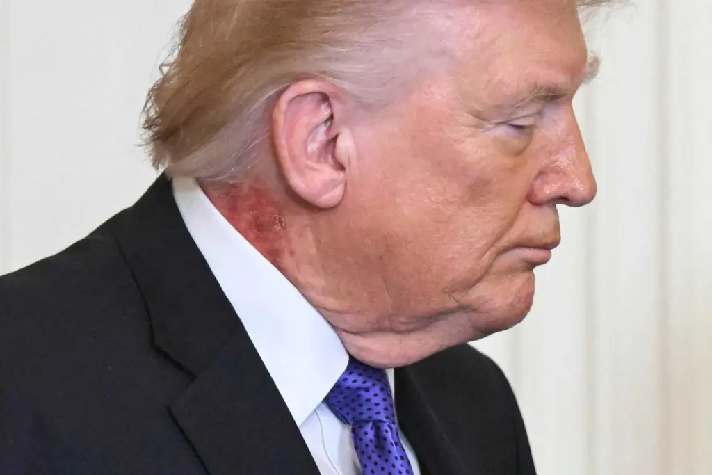 Redness on Trump's neck is caused by common skin cream, White House says