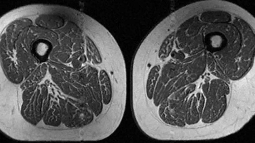 Ultraprocessed foods are turning human thighs into well-marbled steaks