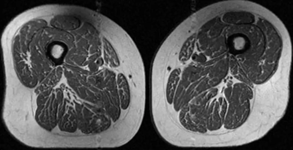 Ultraprocessed foods are turning human thighs into well-marbled steaks
