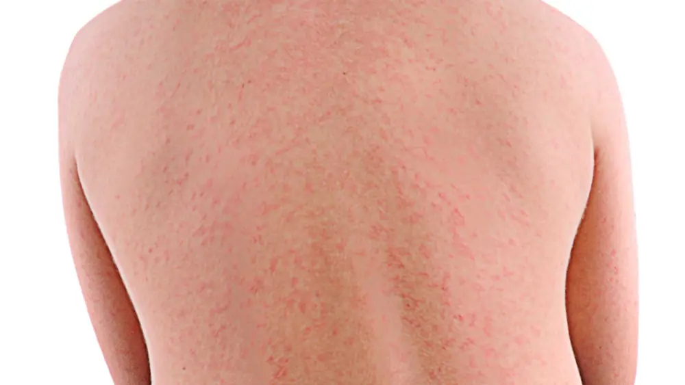Georgia tracking new measles cases after family travels internationally