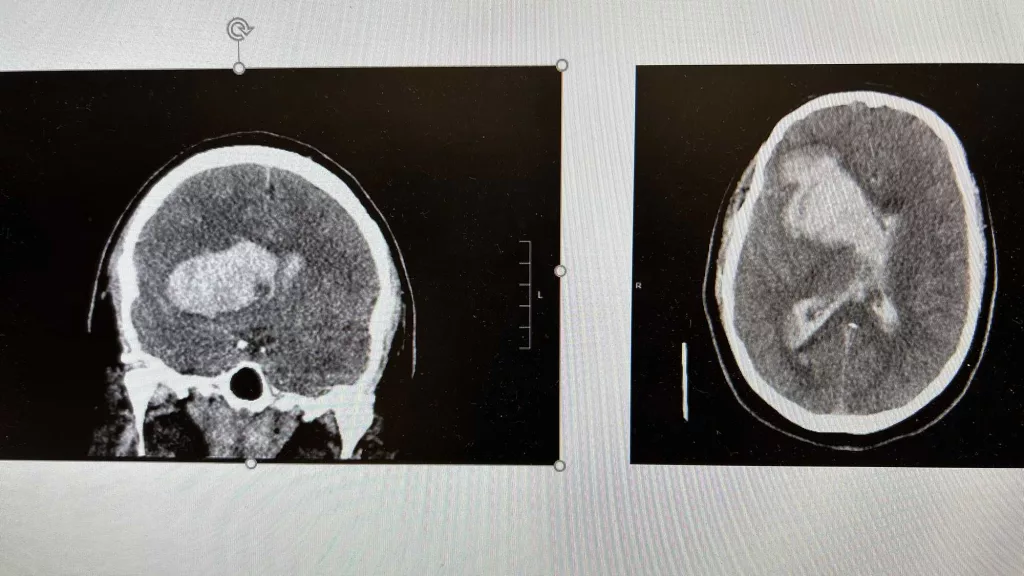 casey-brewer-stroke-ct-scan-66d757d25eb76598869