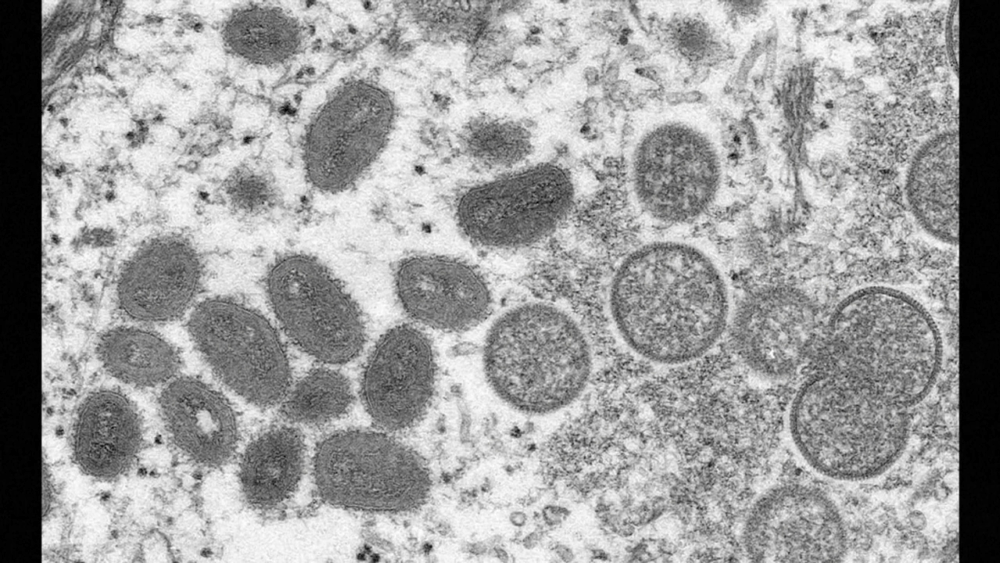 Mpox declared public health emergency: What you need to know