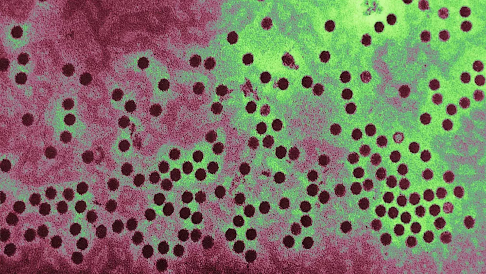 Common respiratory virus is on the rise, CDC warns, with higher risk for certain groups