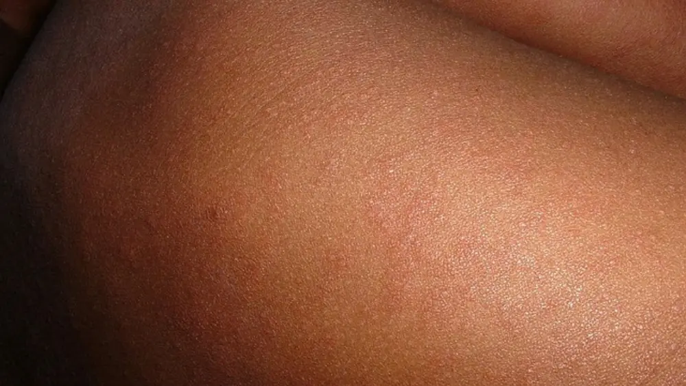 a person with measles