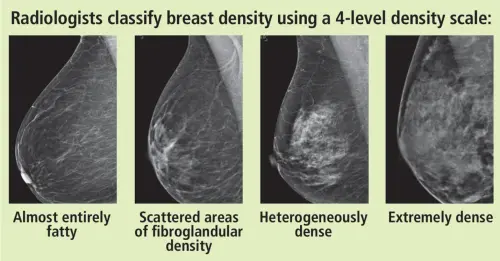 breast_density_scale_1731081170-99731