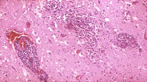west-nile-virus