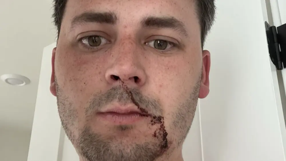 Cam Higby after concussion and other injuries caused by Antifa during ICE protest in Seattle June 14, 2025 Photo courtesy of Cam Higby