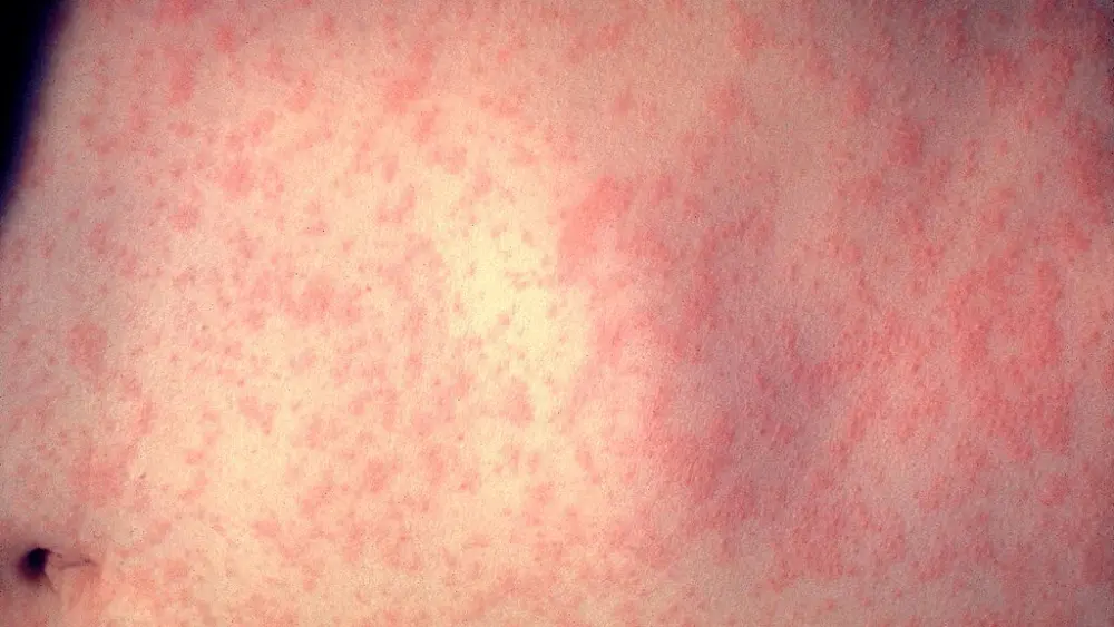 Photo Credit:Content Providers(s): CDC/Dr. Heinz F. Eichenwald, Public domain, via Wikimedia Commons
