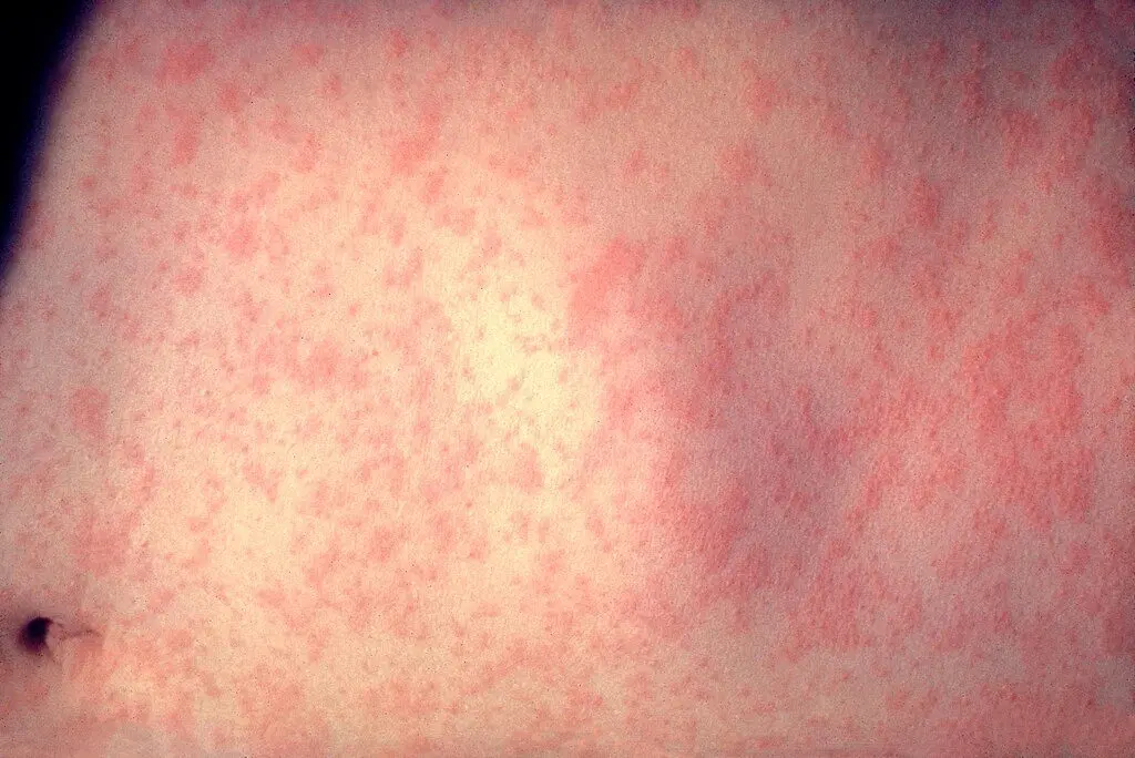 Photo Credit:Content Providers(s): CDC/Dr. Heinz F. Eichenwald, Public domain, via Wikimedia Commons