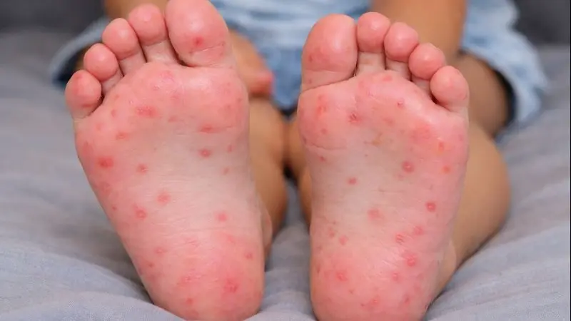 Hand, Foot, and Mouth Disease