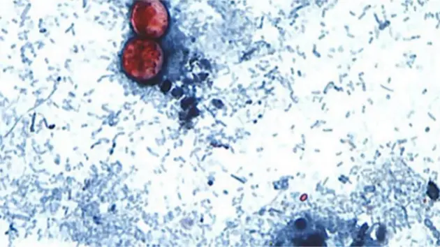 news_cyclosporiasis_72026405914