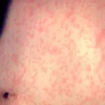 measles-rash-150x150777794-1