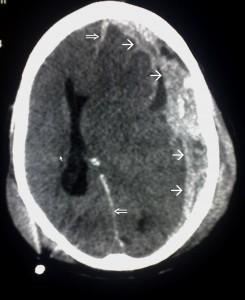 Trauma_subdural_arrows