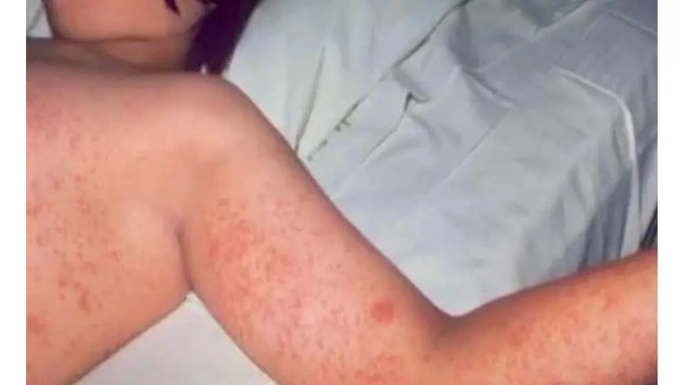 measles-logo-3