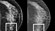 The image on the left is an example of 2D mammography while the image on the right depicts a 3D tomosynthesis image. The white squares indicate the area that was diagnosed as being breast cancer. 