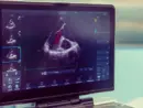 heart-ultrasound