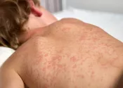 close up of the back of a child laying down in bed with the measles rash on his back
