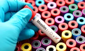 positive Measles vile /test. shows colorful vials in background