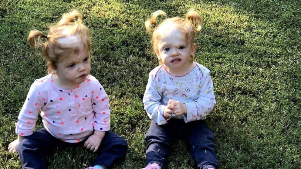 Twins who survived one of the rarest separation surgeries in the world are now thriving toddlers