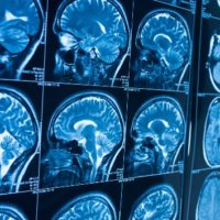 istock_11221_brainscans