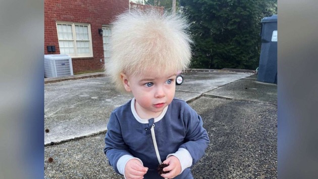 Mom raises awareness after son is diagnosed with uncombable hair syndrome - Vimarsana News
