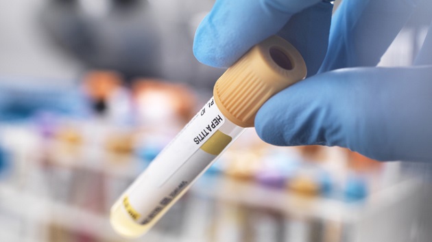 Investigation into mysterious pediatric hepatitis cases in the US expands - Vimarsana News