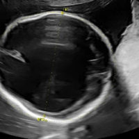 ultrasound-ht-ps-230316_1679001459245_hpembed_1x1_99291681