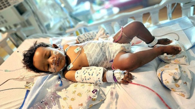 Nurse saves young boy's life by donating part of her liver - Vimarsana News