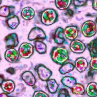 news_measles_012726733152