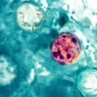 n_cyclosporiasis-ht-jt-270226_1783003202654_hpmain_16x9362426